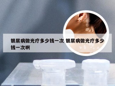 银屑病做光疗多少钱一次 银屑病做光疗多少钱一次啊