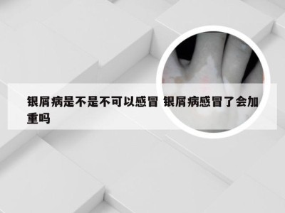 银屑病是不是不可以感冒 银屑病感冒了会加重吗