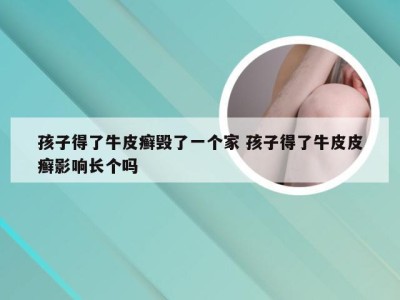 孩子得了牛皮癣毁了一个家 孩子得了牛皮皮癣影响长个吗