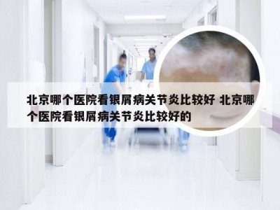 北京哪个医院看银屑病关节炎比较好 北京哪个医院看银屑病关节炎比较好的