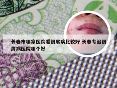 长春市哪家医院看银屑病比较好 长春专治银屑病医院哪个好