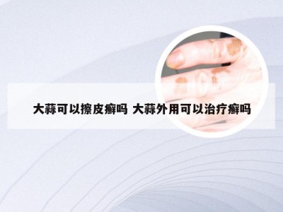 大蒜可以擦皮癣吗 大蒜外用可以治疗癣吗