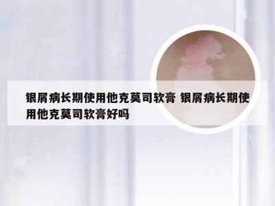 银屑病长期使用他克莫司软膏 银屑病长期使用他克莫司软膏好吗