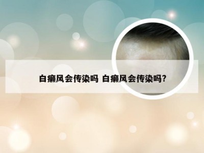 白癞风会传染吗 白癞风会传染吗?