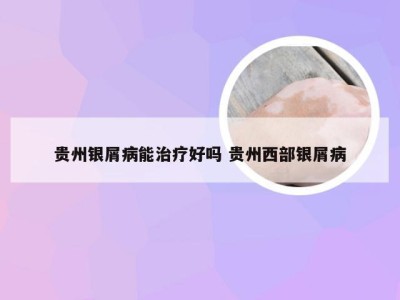 贵州银屑病能治疗好吗 贵州西部银屑病