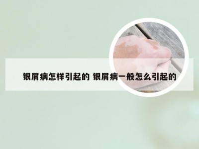 银屑病怎样引起的 银屑病一般怎么引起的