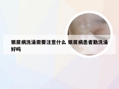 银屑病洗澡需要注意什么 银屑病患者勤洗澡好吗