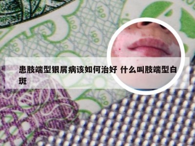 患肢端型银屑病该如何治好 什么叫肢端型白斑