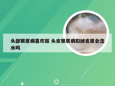 头部银屑病喜欢抠 头皮银屑病扣掉皮屑会流水吗