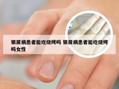 银屑病患者能吃烧烤吗 银屑病患者能吃烧烤吗女性