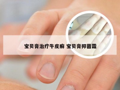 宝贝膏治疗牛皮癣 宝贝膏抑菌霜