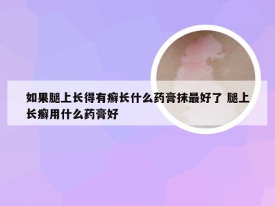 如果腿上长得有癣长什么药膏抹最好了 腿上长癣用什么药膏好