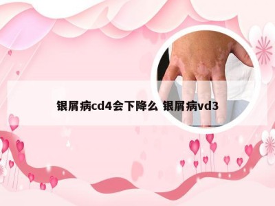 银屑病cd4会下降么 银屑病vd3