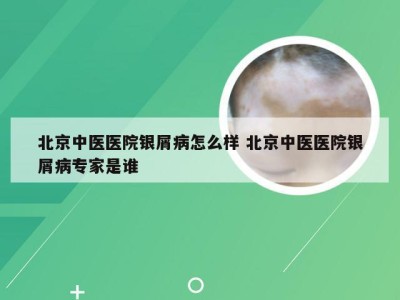 北京中医医院银屑病怎么样 北京中医医院银屑病专家是谁