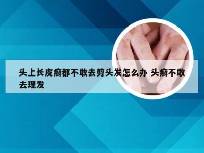 头上长皮癣都不敢去剪头发怎么办 头癣不敢去理发