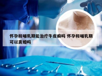 怀孕和哺乳期能治疗牛皮癣吗 怀孕和哺乳期可以离婚吗