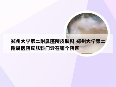 郑州大学第二附属医院皮肤科 郑州大学第二附属医院皮肤科门诊在哪个院区