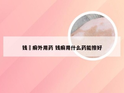 钱帀癣外用药 钱癣用什么药能擦好