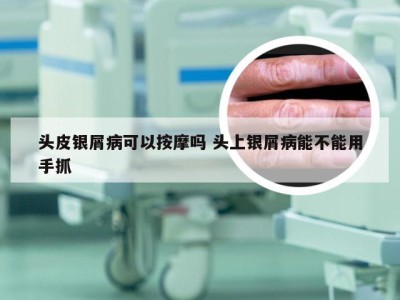 头皮银屑病可以按摩吗 头上银屑病能不能用手抓