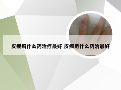 皮疲癣什么药治疗最好 皮癣用什么药治最好