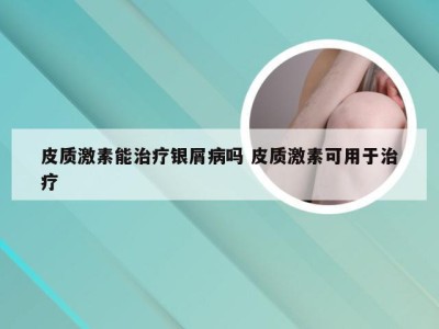 皮质激素能治疗银屑病吗 皮质激素可用于治疗