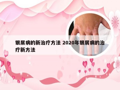 银屑病的新治疗方法 2020年银屑病的治疗新方法