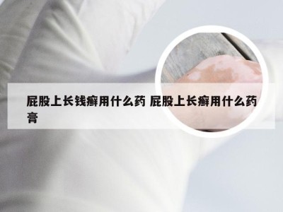 屁股上长钱癣用什么药 屁股上长癣用什么药膏