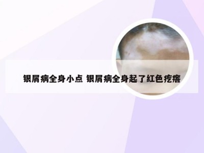 银屑病全身小点 银屑病全身起了红色疙瘩