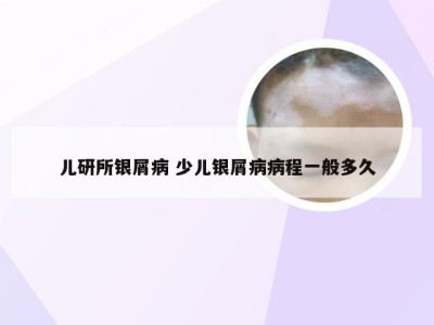 儿研所银屑病 少儿银屑病病程一般多久