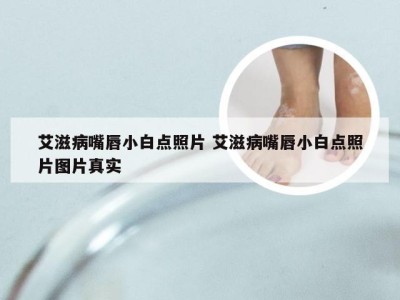 艾滋病嘴唇小白点照片 艾滋病嘴唇小白点照片图片真实