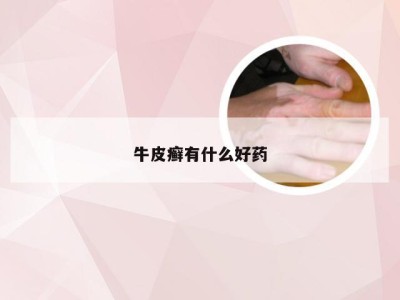 牛皮癣有什么好药