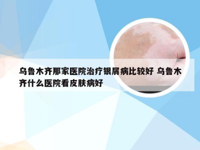 乌鲁木齐那家医院治疗银屑病比较好 乌鲁木齐什么医院看皮肤病好