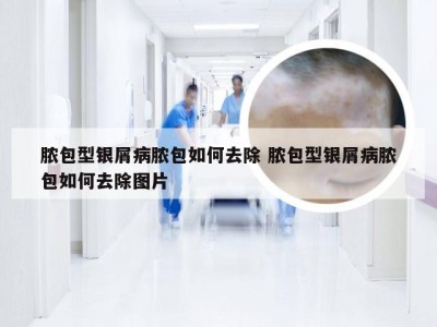 脓包型银屑病脓包如何去除 脓包型银屑病脓包如何去除图片