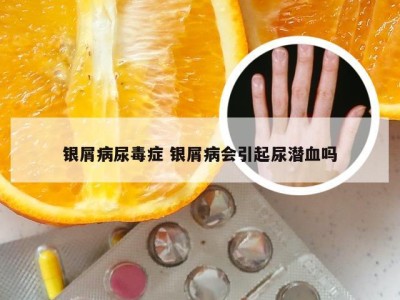 银屑病尿毒症 银屑病会引起尿潜血吗