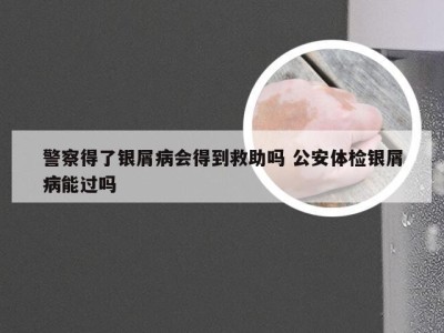 警察得了银屑病会得到救助吗 公安体检银屑病能过吗