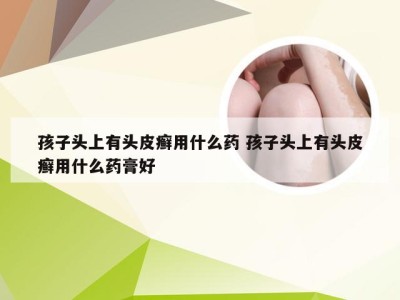 孩子头上有头皮癣用什么药 孩子头上有头皮癣用什么药膏好