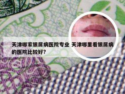 天津哪家银屑病医院专业 天津哪里看银屑病的医院比较好?