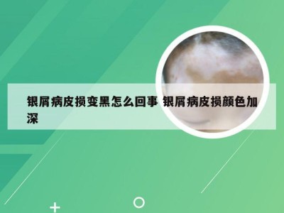 银屑病皮损变黑怎么回事 银屑病皮损颜色加深