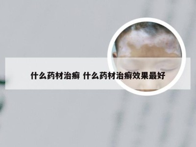 什么药材治癣 什么药材治癣效果最好