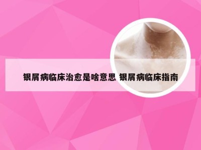 银屑病临床治愈是啥意思 银屑病临床指南