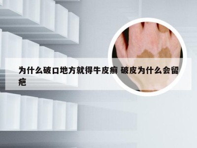 为什么破口地方就得牛皮癣 破皮为什么会留疤