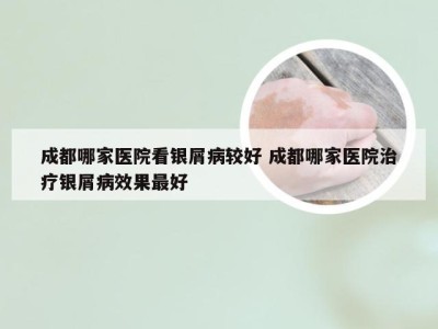 成都哪家医院看银屑病较好 成都哪家医院治疗银屑病效果最好