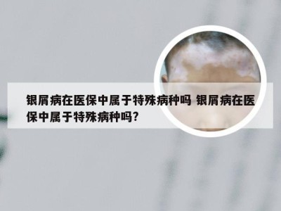 银屑病在医保中属于特殊病种吗 银屑病在医保中属于特殊病种吗?