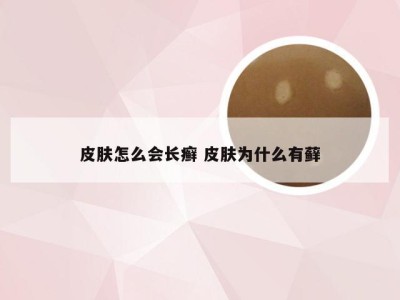 皮肤怎么会长癣 皮肤为什么有藓