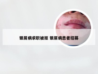 银屑病求职被拒 银屑病患者招募