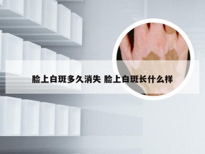 脸上白斑多久消失 脸上白斑长什么样