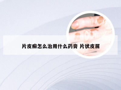 片皮癣怎么治用什么药膏 片状皮屑