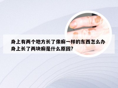 身上有两个地方长了像癣一样的东西怎么办 身上长了两块癣是什么原因?