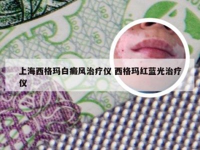 上海西格玛白癜风治疗仪 西格玛红蓝光治疗仪