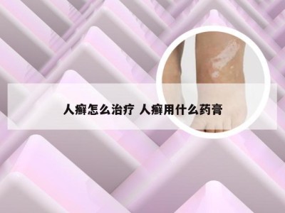 人癣怎么治疗 人癣用什么药膏